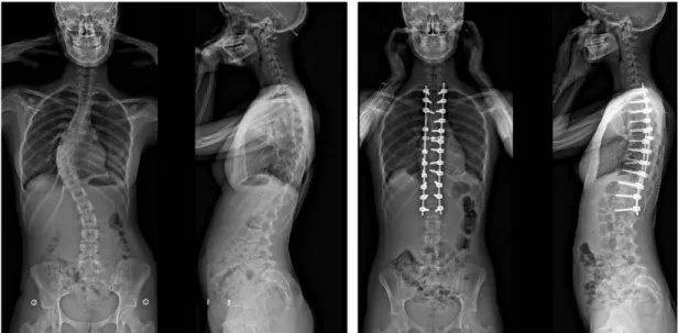Figure 22 : Scoliose thoracique opérée à l’aide d’un montage par vis pédiculaires  (groupe 1) 