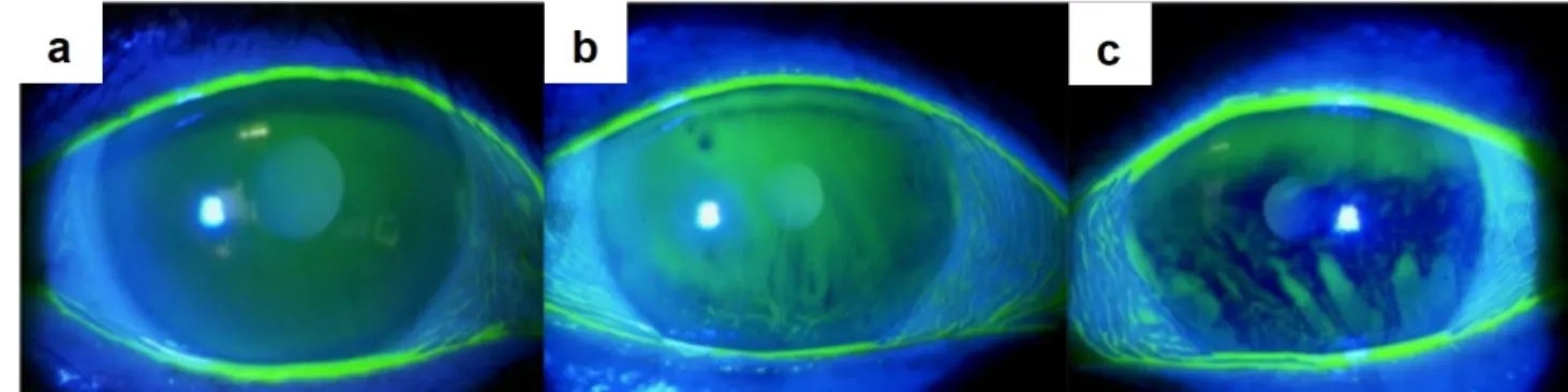 Figure 5.2 – Measurement of tear break-up time. Fluorescein is introduced into the eye (a-b) With time the dark spots, corresponding to breaks in tear film, appear
