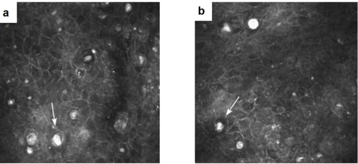 Figure 1.14 – Confocal microscopy in diagnosis of Acanthamoeba keratitis. Characteristic round 20