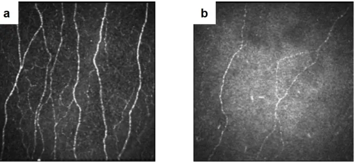Figure 1.16 – Confocal microscopy recognizes difference in nerve densities in normal and diabetic subjects