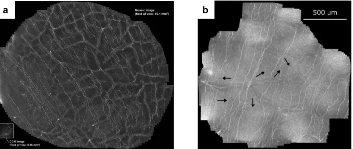 Figure 2.6 – Stitched contact confocal microscopy images of sub-basal nerves. (a) Large field of view (16 mm 2 ) image of SNP, obtained by stitching 2541 images [62]