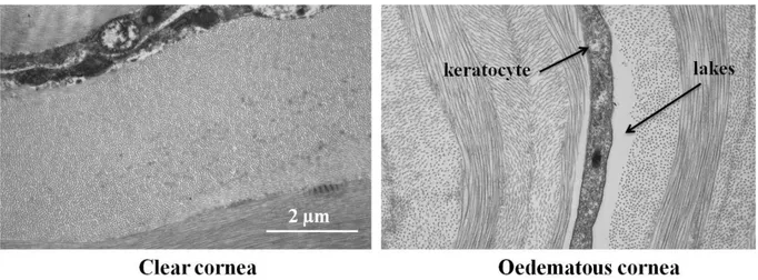 Fig. 1. 8:  A comparison of clear and oedematous cornea. Keratocytes and lakes are visible in 