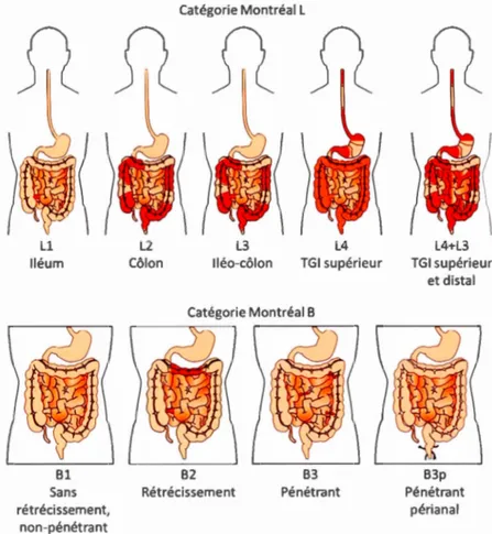 Figure 1.3  Phénotypes  de  la  maladie  de  Crohn.  Le  cl asse m e nt  co mp o rt e  d e u x 