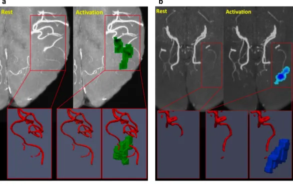 Figure 3.9 shows the MCA and the PCA in VED filtered ToF images and two fiMRE activation regions (in blue and green, representing the decrease and increase of µ, respectively) that did not appear to be related to the arteries.