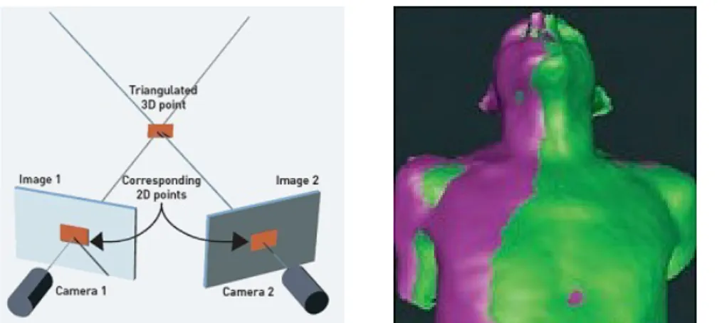 Figure 13: Fonctionnement du système AlignRT (© VisionRT). Deux caméras  permettent de reconstruire la surface 3D du patient qui sera alors comparée 