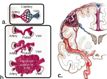 Figure 2: (a) Illustration of the normal arterial-capillary-venous relationship. (b) Drawing of the failure of normal capillary genesis, a fistular connection between the developing artery and vein occurs, which causes an arterial shunting of blood with ar