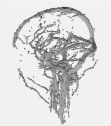 Figure 11: Brain vessels segmentation based on grey-level hit-or-miss transform. Illustration is from [ NPR07 ].