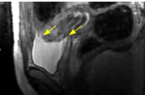 Figure 1.2: Example of motion artifact on a sagittal slice of a T2-w MRI, which produces blurred and repeated structures borders (yellow arrows).