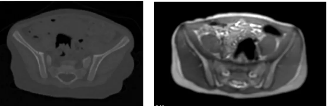 Figure 3.1: Comparison between pelvic CT and MRI images.