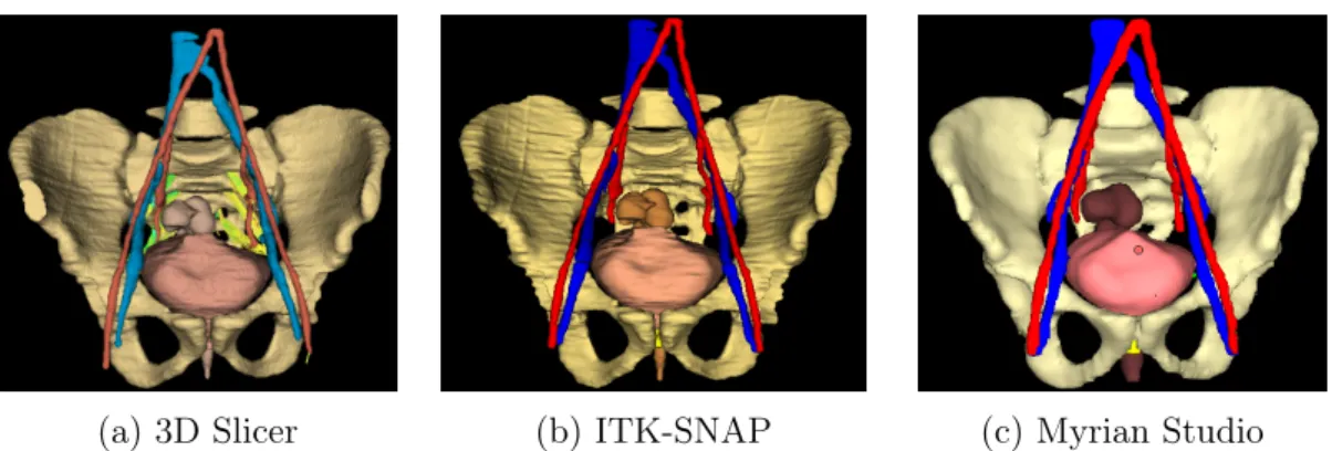 Figure 4.1: Example of 3D pelvic reconstructions obtained through segmentation of the volumetric T2-w MRI.
