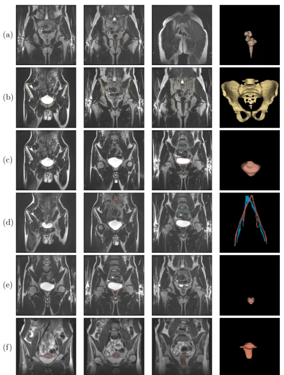 Figure 4.2: Example of organs segmentations in a few MRI coronal slices. From top to bottom: (a) rectum, (b) bones, (c) bladder, (d) veins (blue) and arteries (red), (e) prostate, and (f) uterus.