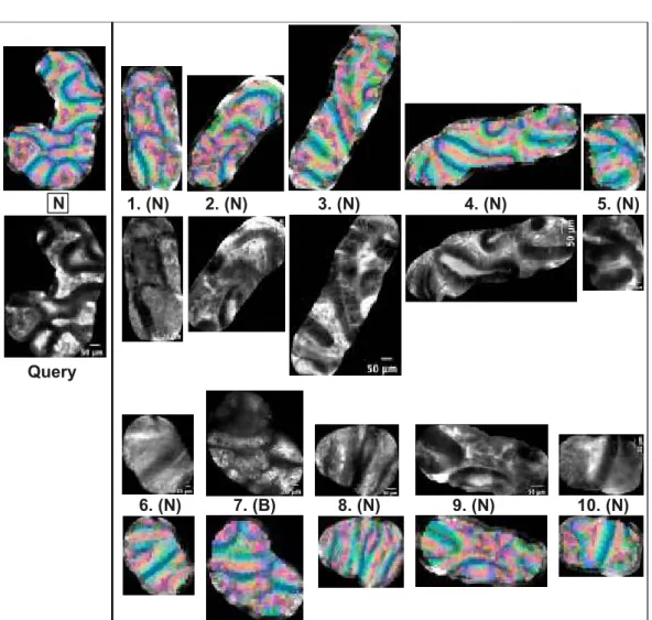 Figure 2.18: The 10 most similar pCLE video sub-sequences (right) for a neoplastic query (left), retrieved by the LOPO Weighted-ImOfMos method