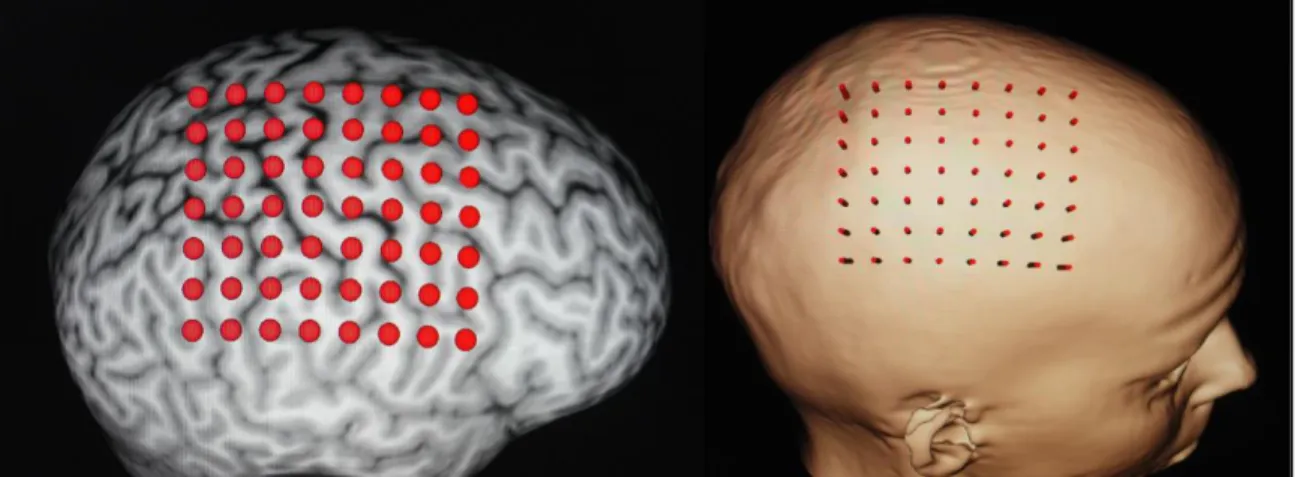 Fig. 1 Grid of points on the reconstructed brain. Mapping was performed by successively stimulating the  different sites on the grid, starting at the hotspot, until the map was surrounded by inactive sites (number of  MEPs≤1 out of six stimulations)  