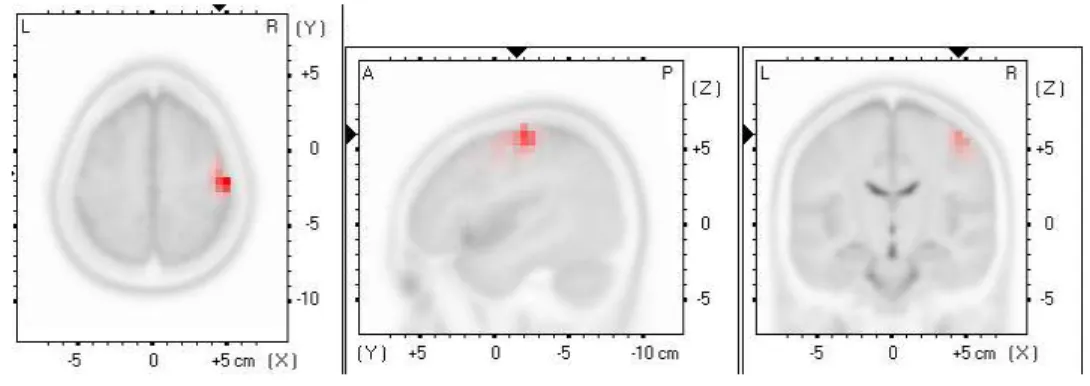 Figure  3.  A  pain-evoked  increase  in  the  right  primary  motor  cortex  activity  during  the  “pain” 