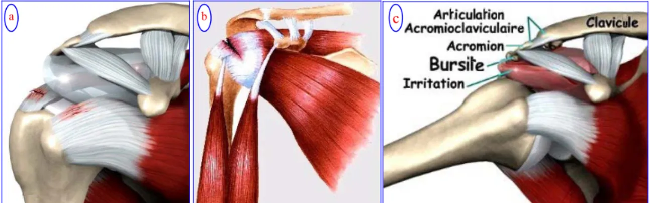 Figure II-13 : Les pathologies de l’épaule chez l’utilisateur du FRM. (a : lésion de la coiffe ; b : rupture de la  coiffe ; c : bursite) [ www.mosmc.com ]