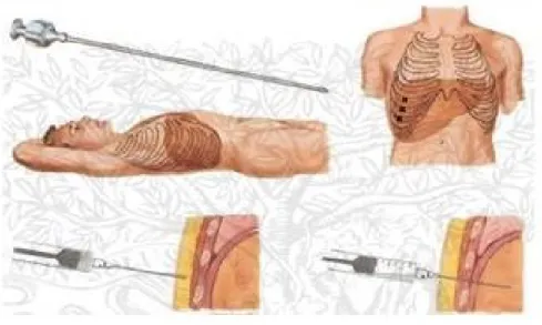 Figure 10 : Insertion site for liver percutaneous interventions [3]. 
