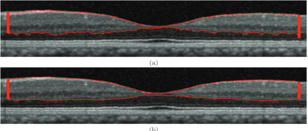 Figure 2.6 – Eﬀet de régularisation par contour actif pour la segmentation de l’interface OPL/ONL