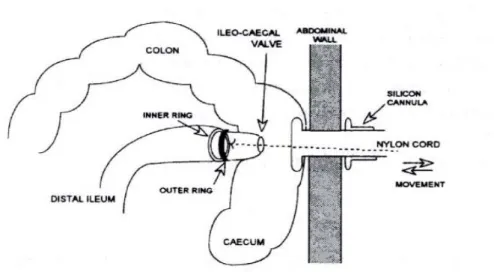 Figure 5.  Steered ileal-caecal valve cannula used in pigs for ileal digesta collection