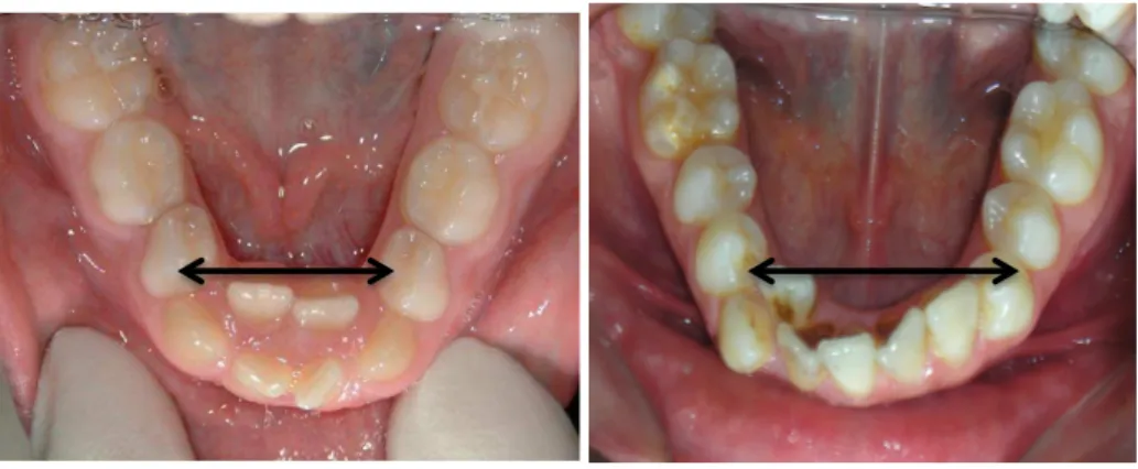 Figure 3 : encombrement incisif mandibulaire sévère lié à une insuffisance de croissance transversale de la  mandibule