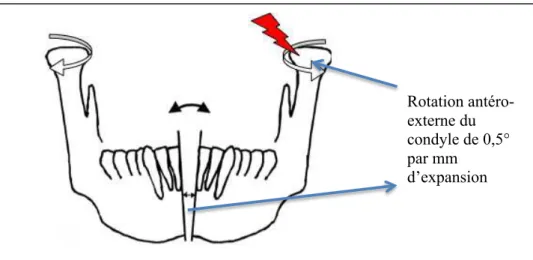 Figure 8 : représentation des modifications anatomiques condyliennes après distraction symphysaire et du  risque de dysfonction