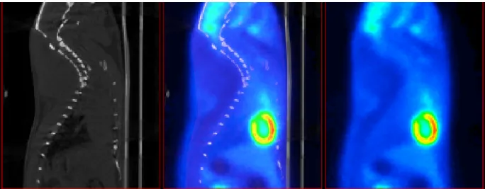 Figure 1.1 Exemple de comparaison entre une image structurelle et une image métabolique