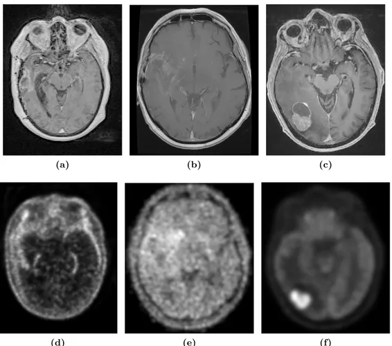 Figure 1.6 : Images TEP et IRM d’un même patient. Images IRM T1-Gd (a) et 18 F -choline TEP (d) d’un