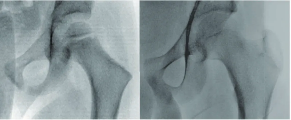 Figure 3 – Radiographie de la hanche droite d’un enfant de 3 ans (gauche) et d’un enfant de 17 ans (droite)