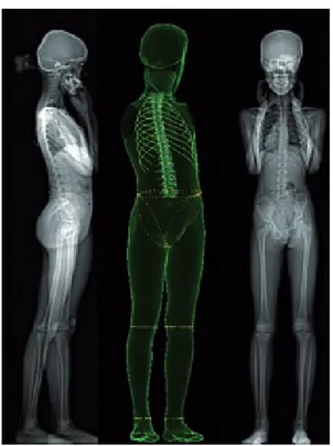 Figure 26 – Reconstruction personnalisée 3D d’une fille de 12,3 ans à partir de 2 radiographies
