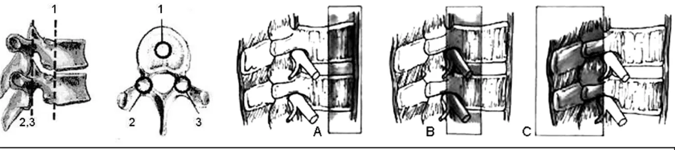 Figure 10 : Les trois colonnes assurant la  stabilité rachidienne  Dubousset'94;Larson'99 