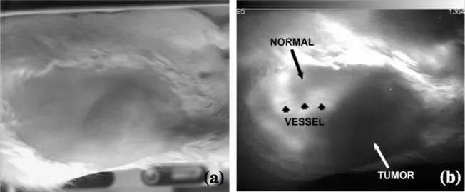 Figure I.10 – a) Light scattering image under ambient light. b) Corresponding autoﬂuorescence image with an excitation at 670 nm and a detection at 800 nm [34].