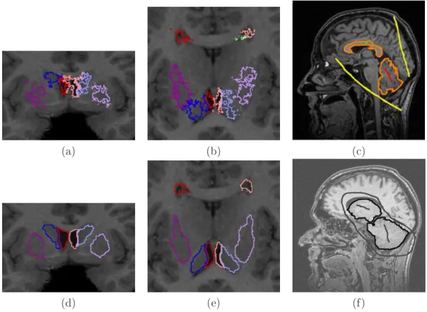 Figure 1.4  Exemples de segmentation semi-automatique. L'algorithme de  graph- graph-shifts  [Corso et al., 2007] permet d'aner une segmentation initiale (a) et (b)