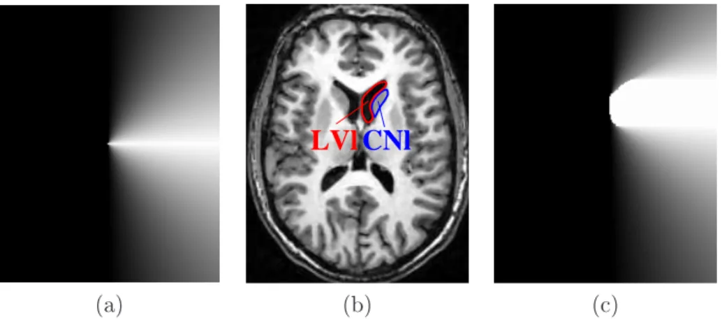 Figure 2.8  (a) Élément structurant ν correspondant à la direction  à droite de . (b) Le noyau caudé gauche CNl est situé à droite du ventricule latéral droit LV l