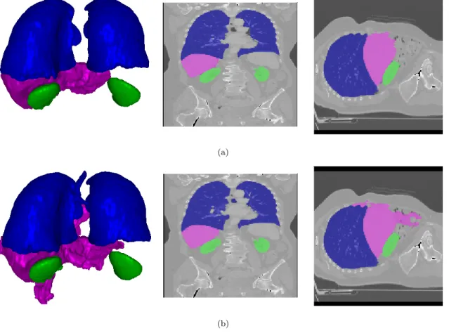Figure 3.8: CT image of the thorax (256x256x128). (a) Surface Rendering and orthogonal cuts of the original data surimposed with the presented segmentation method