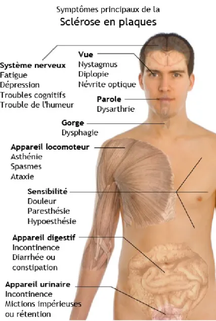 Figure 2 : Symptômes principaux de la SEP. 
