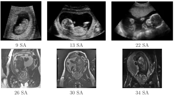 Fig. 1.15 – Coupes extraites d’images tri-dimensionnelles acquises en échographie (en haut) et en IRM (en bas) à diﬀérents stades de la grossesse.
