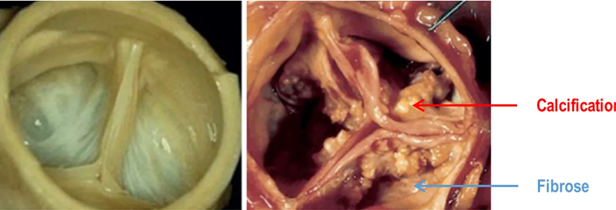 Figure 1-8 : Observations macroscopiques d'une valve saine (à gauche) et d'une valve sténosée (à droite) et  ayant accumulé des dépôts calciques (en rouge) et fibrotiques (en bleu) 95 .
