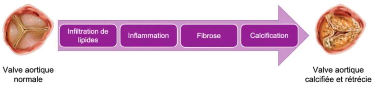 Figure 4. Représentation d'une valve aortique normale et d'une valve aortique calcifiée après plusieurs  étapes du développement de la sténose aortique