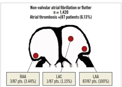 Figure  6.  Localization  of  left  atrial  thrombi  in  patients  with  non-valvular  atrial  fibrillation or flutter