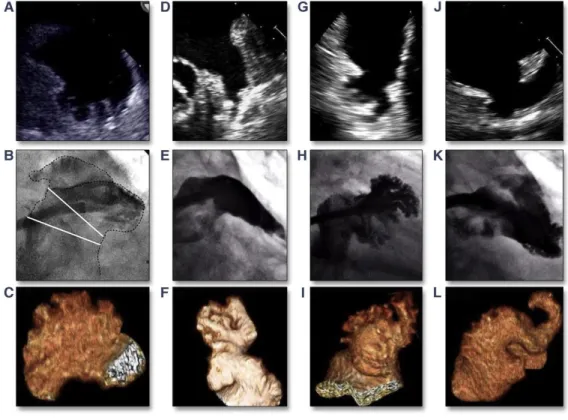 Figure 8. Multimodality imaging morphological classification of the LAA assessed by  transesophageal  imaging  (top),  angiography  (middle)  and  computed  tomography  (bottom)