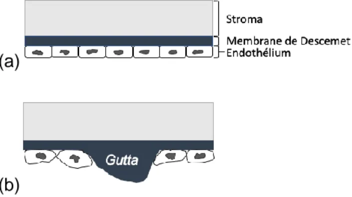 Figure 5 Guttae.  (a) Endothélium et membrane de Descemet sains. (Source :  Isabelle Xu) (b) Endothélium et membrane de Descemet atteints de dystrophie 