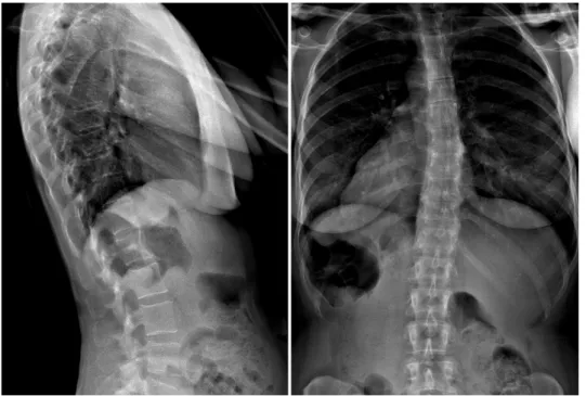 Figure 2.2 – Radiographie standard de profil (gauche) et de face (droite). biphotonique à rayons X (DXA)