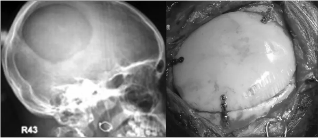 Figure I.14. a) Radiographie montrant un defect cranial et b) reconstruction du defect à l'aide d'une plaque en polymère (Mantri et al., 2012).