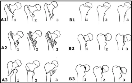 Figure 5: Classification des fractures de l’extrémité supérieure du fémur, selon Müller [MULL80,  SCAR02] 