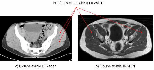 Figure 19 : Coupe axial CT-scan (a) et IRM (b, séquence T1) au niveau de la hanche. Les interfaces entre  les muscles sont difficilement discernables