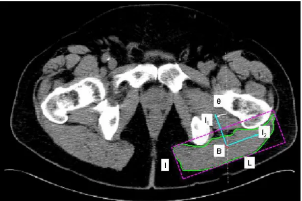 Figure 24 : Position du barycentre (B), orientation ( θ ) de l’axe d’inertie principale I 1 , largeur (l) et longueur  (L) du rectangle externe pour le contour du muscle Gluteus maximus 
