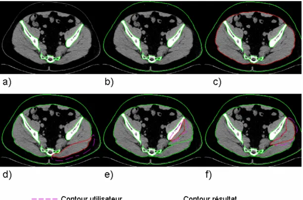 Figure 29 : Étapes de contourage  Les étapes du contourage sont alors les suivantes : 