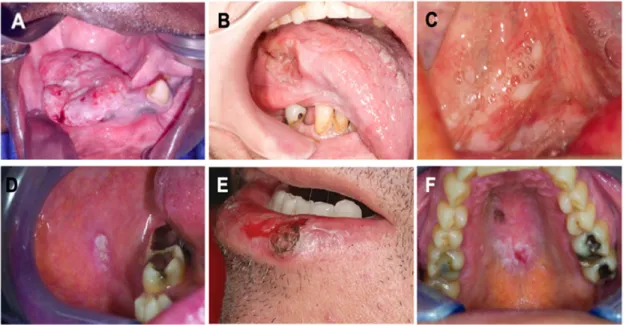 Figure 2 . Cancers épidermoïdes de différentes régions de la cavité buccale. A) Gencive