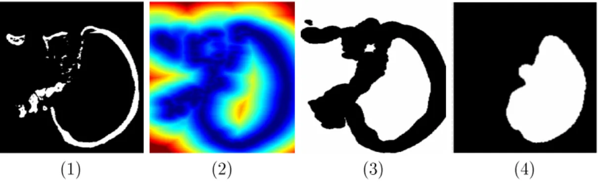 Fig. 2.1  Exemple de fermeture conditionnelle pour la segmentation du cerveau (tomodensitométrie issue du &#34;Visible Human 2.0&#34;)