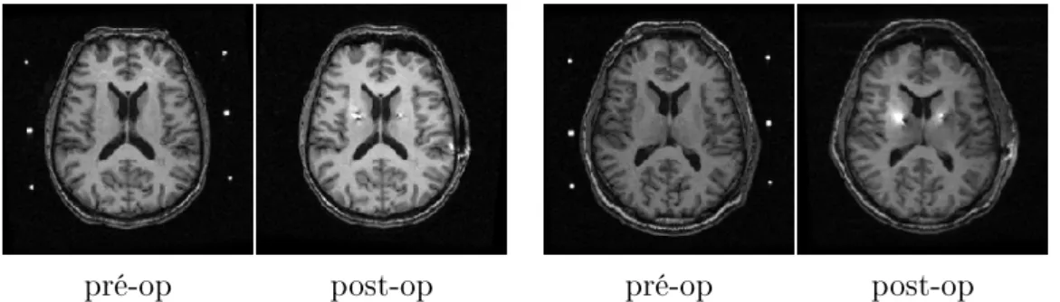 Fig. 3.4  Deux ensembles d'images extraits des 7 IRMs pondérées T1 pré et post opératoires