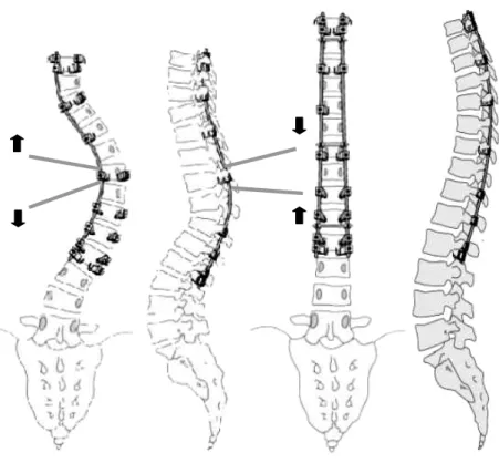 Figure 1-16 : Instrumentation de quatrième génération  Technique du modelage in situ d’après  Steib et Mitulescu, 2002